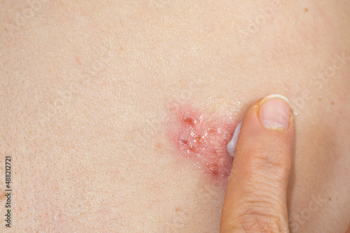 Herpes Zoster (shingles) on the skin, close up. Medicinal ointment for treatment