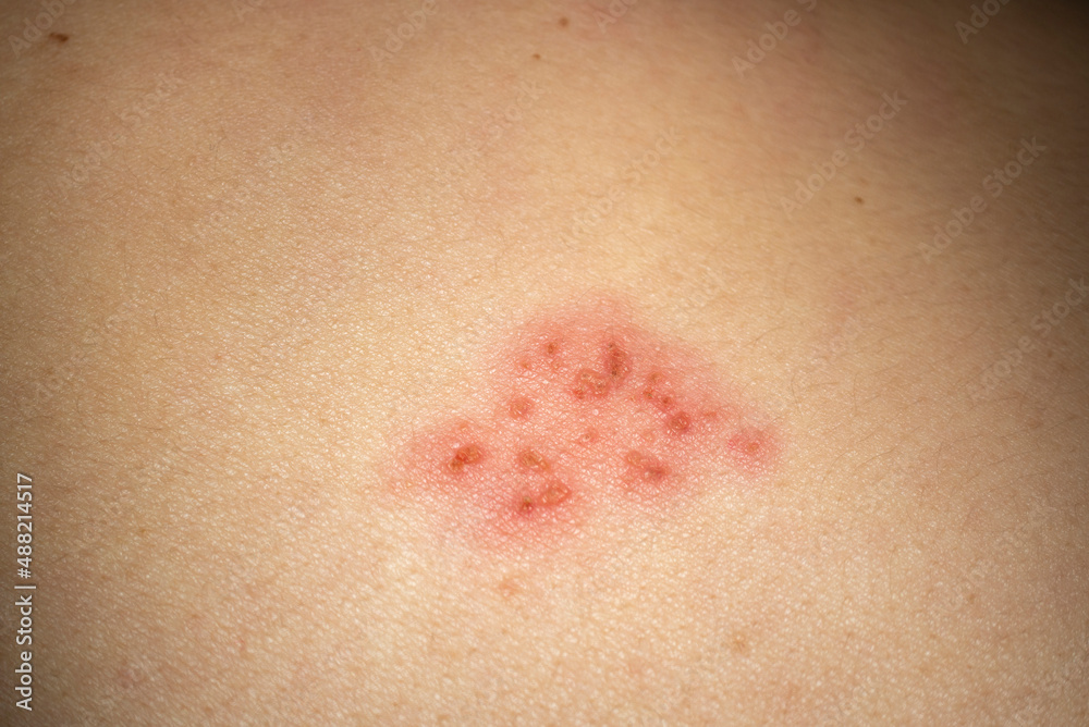 Herpes Zoster (shingles) on the skin, close up. Herpes Zoster (shingles) on the skin, close up.