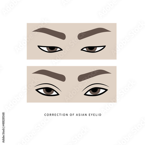 Plastic surgery for formation of upper eyelid