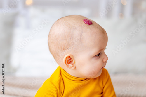a baby with a hemangioma or a red benign tumor on the head from birth, portrait or close-up