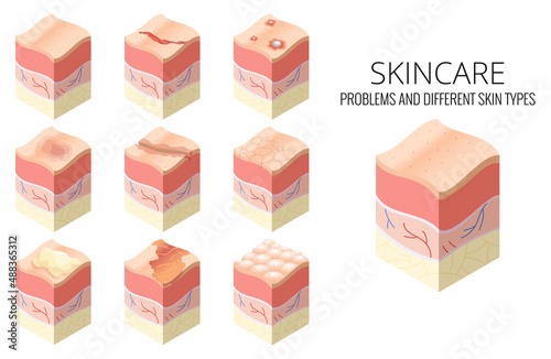 Skincare medical concept. Set of problems of different skin types in cross-section of human skin horizontal layers structure