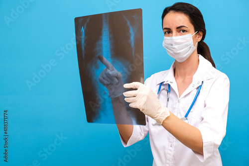 the doctor holds an X-ray of the spine in his hands, the patient has scaliosis. photo