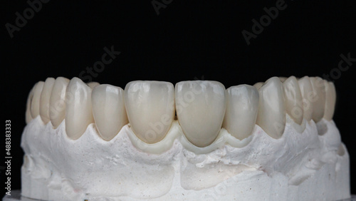 excellent dental veneers and ceramic crowns on the model of the upper jaw on a black background