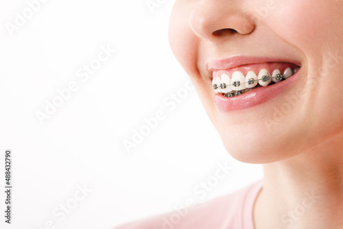 Orthodontic Treatment. Dental Care Concept. Beautiful Woman Healthy Smile close up. Closeup Ceramic and Metal Brackets on Teeth. Beautiful Female Smile with Braces