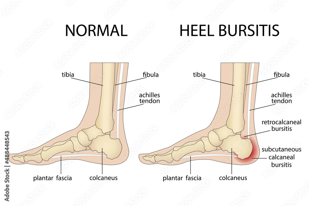 Calcaneal bursitis. Foot with normal heel and foot with Haglund's