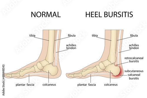 Calcaneal bursitis. Foot with normal heel and foot with Haglund's deformity and bursitis photo