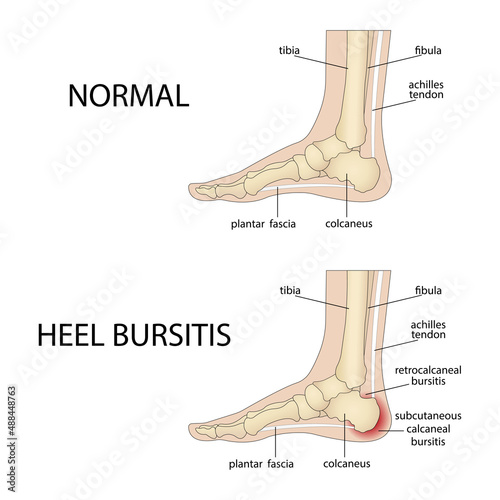 Calcaneal bursitis. Foot with normal heel and foot with Haglund's deformity and bursitis photo