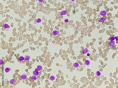 1000x, abnormal, acute, all, aml, analyzing, apl, blast, blood, bone, cancer, care, cbc, cell, chronic, cll, cml, complete, count, disease, eosinophil, erythrocyte, exam, film, health, hematology, hem photo