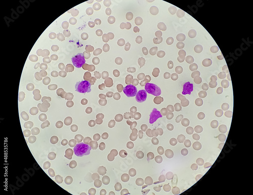 Acute Promyelocytic Leukamia (APL) analyzed by microscope. It is an aggressive type of acute myeloid leukemia. photo