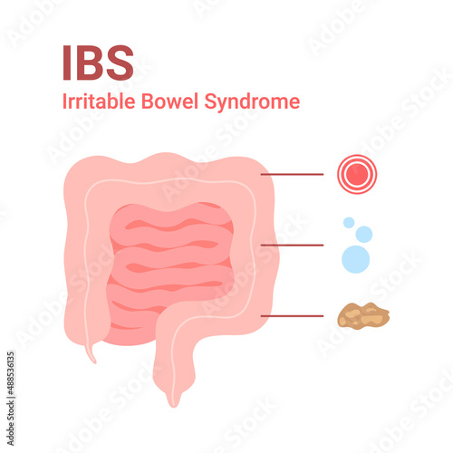 Irritable bowel syndrome, IBS. Symptoms in intestine pain, bloating and diarrhea. Vector illustration