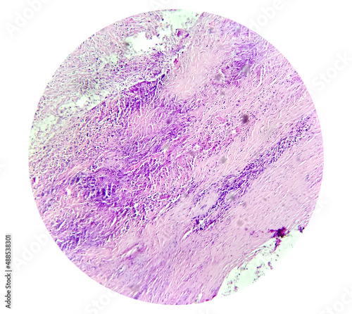 Tissue form Gallbladder (Laparoscopic cholecysectomy) hematoxylin and eosin stained microscopic show Carcinosarcoma of gallbladder. Gallbladder cancer photo