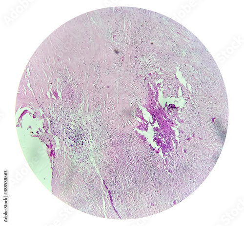 Carcinosarcoma of gallbladder. Histology analyzed by microscope. Gallbladder cancer photo