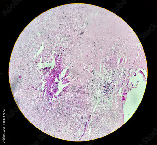 Carcinosarcoma of gallbladder. Histology analyzed by microscope. Gallbladder cancer photo