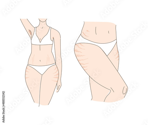 Woman and stretch marks. Wears white panties and bra