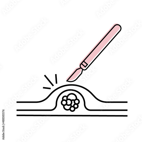 Scalpel skin incision icon. tumor and sebaceous gland surgery icon.
