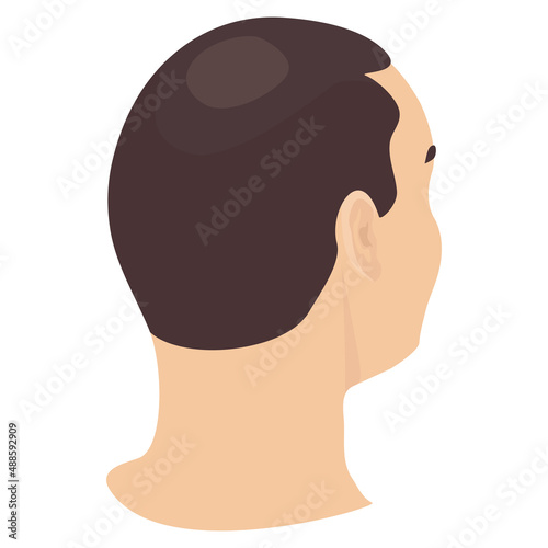 Head of a man with hair loss in side view. Different stages of alopecia in men. Health care and beauty concept. Vector cartoon illustration