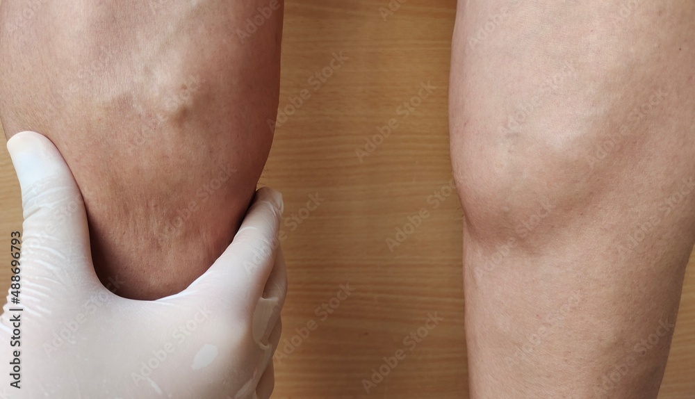 Fototapeta premium Portrait the calf muscles and blood vessels on the legs of woman, concept health care.