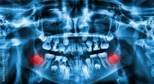 Panoramic x-ray image of teeth