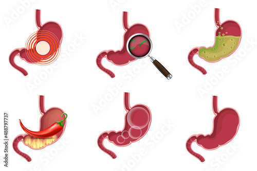 Healthy and unhealthy, empty and full human stomach in trendy flat style. Nutrition, stomach pain, bloating. Digestive system anatomy. Vector illustration isolated on white background.