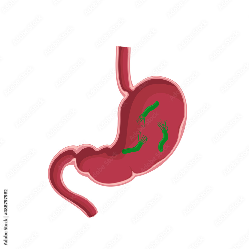 Human stomach infected Helicobacter Pilori. Medical concept. Stomach disease illustration on white background. Human stomach infected Helicobacter Pilori. Medical concept. Stomach disease illustration on white background.
