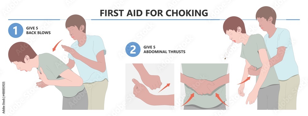 Choking First Aid Baby Food CPR Child Step Lodges Blocking Victim Adult 