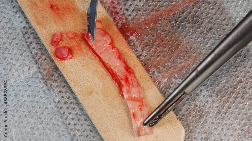 soft tissue graft flap for implantation into the gum during dental implantation or surgery