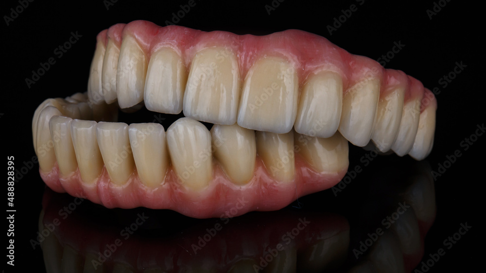 two ceramic prostheses on titanium beams for the upper and lower jaws on a black background two ceramic prostheses on titanium beams for the upper and lower jaws on a black background