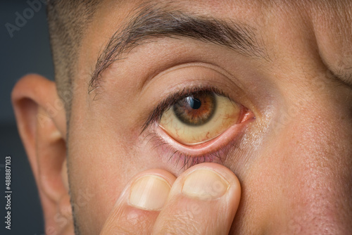 Sick man checking yellow eyes because of high bilirubin level, cirrhosis or hepatitis. Liver disease, liver problems or jaundice