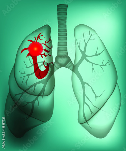 The illustration of sick lungs with a sickness in them. The illustration was made in such a way that to create a concept of rentgenogramma or x-ray. Vector illustration.