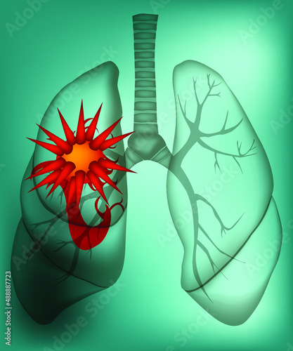 The illustration of rentgenogramma or x-ray of sick lungs with a great sickness in them. This can be useful as a medical concept. Vector illustration.