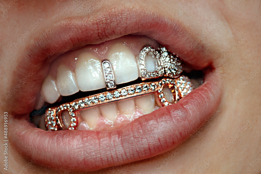 Grillz - Dental Jewelry Photos