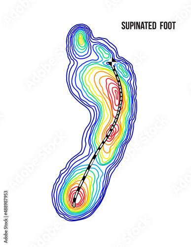 Supinated foot, arch deformation, bottom view. Foot weight distribution.