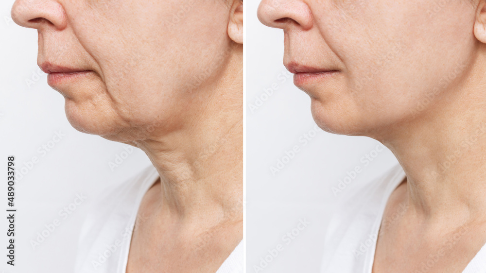 Obraz premium The lower part of the face and neck of an elderly woman with signs of skin aging before and after facelift, plastic surgery isolated on a white background. Age-related changes, flabby sagging skin