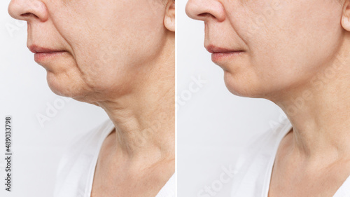 The lower part of the face and neck of an elderly woman with signs of skin aging before and after facelift, plastic surgery isolated on a white background. Age-related changes, flabby sagging skin photo