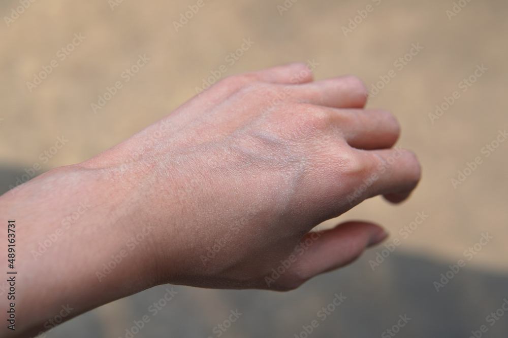 Closeup Dry irritated thin skin adults woman’s hand facing sunlight in a day time with outside street as background. How to prevent from Skin sunburn, healthcare concept Closeup Dry irritated thin skin adults woman’s hand facing sunlight in a day time with outside street as background. How to prevent from Skin sunburn, healthcare concept