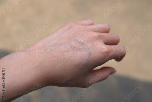 Closeup Dry irritated thin skin adults woman’s hand facing sunlight in a day time with outside street as background. How to prevent from Skin sunburn, healthcare concept © 9gifts