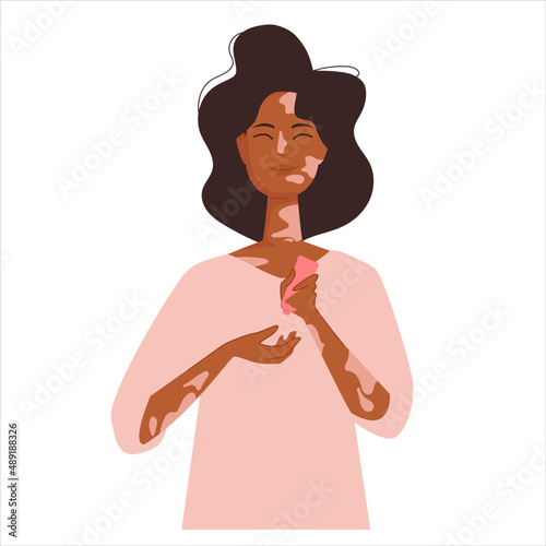 Cute girl with vitiligo take care with hand cream. Everyday cosmetic treatment for healthy glowing treatment. Vector illustration isolated on white background. 