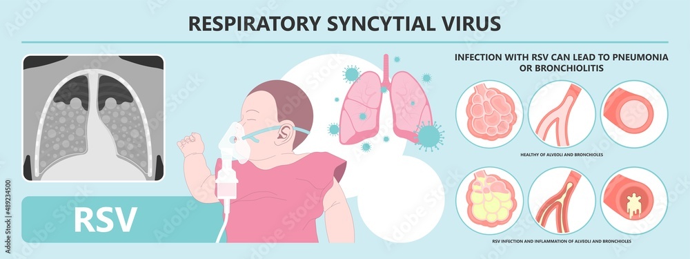 Obraz premium RSV virus covid 19 common cold flu human baby child viral Care Runny nose Cough Sneezing Fever Wheezing mask ventilator COPD tract kids sound NICU Unit croup treatment antigen rapid test Kit ATK