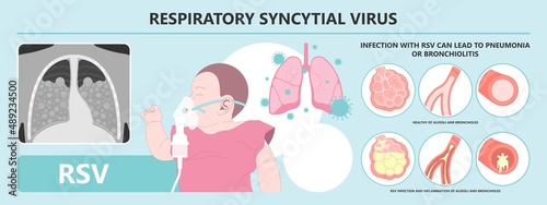 RSV virus covid 19 common cold flu human baby child viral Care Runny nose Cough Sneezing Fever Wheezing mask ventilator COPD tract kids sound NICU Unit croup treatment antigen rapid test Kit ATK