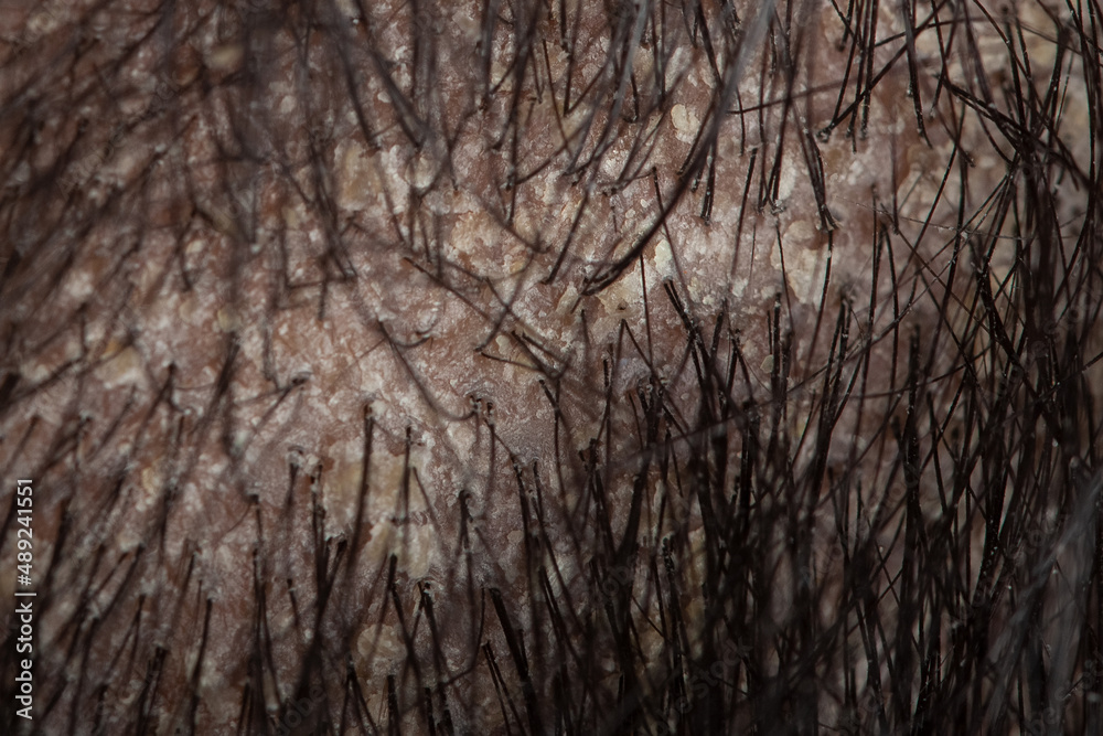 hair root scalp with oily flaky dandruff, seborrheic dermatitis hair root scalp with oily flaky dandruff, seborrheic dermatitis