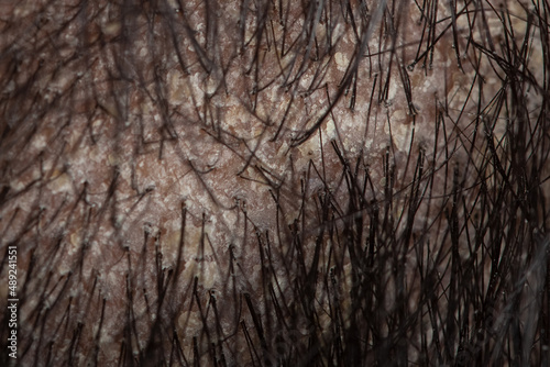 hair root scalp with oily flaky dandruff, seborrheic dermatitis