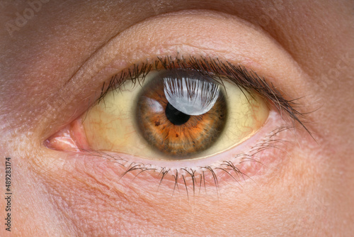 Foto Closeup of yellow eye because of high bilirubin level, cirrhosis or hepatitis