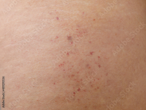 Groups of red spots or petechiae on thigh of adult female patient. Also called bruises caused by vacuum roller massage. Broken cappilaries, vasculitis, inflammation of blood vessel. Macro close up