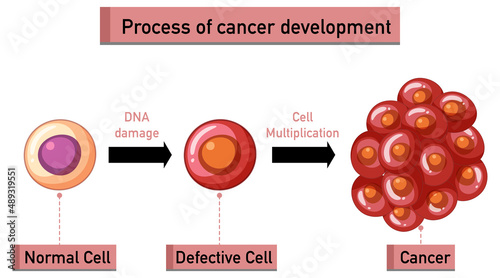 Process of cancer development infographic