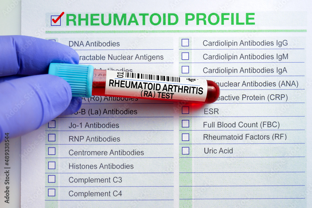 Blood tube test with requisition form for Rheumatoid Arthritis RA test