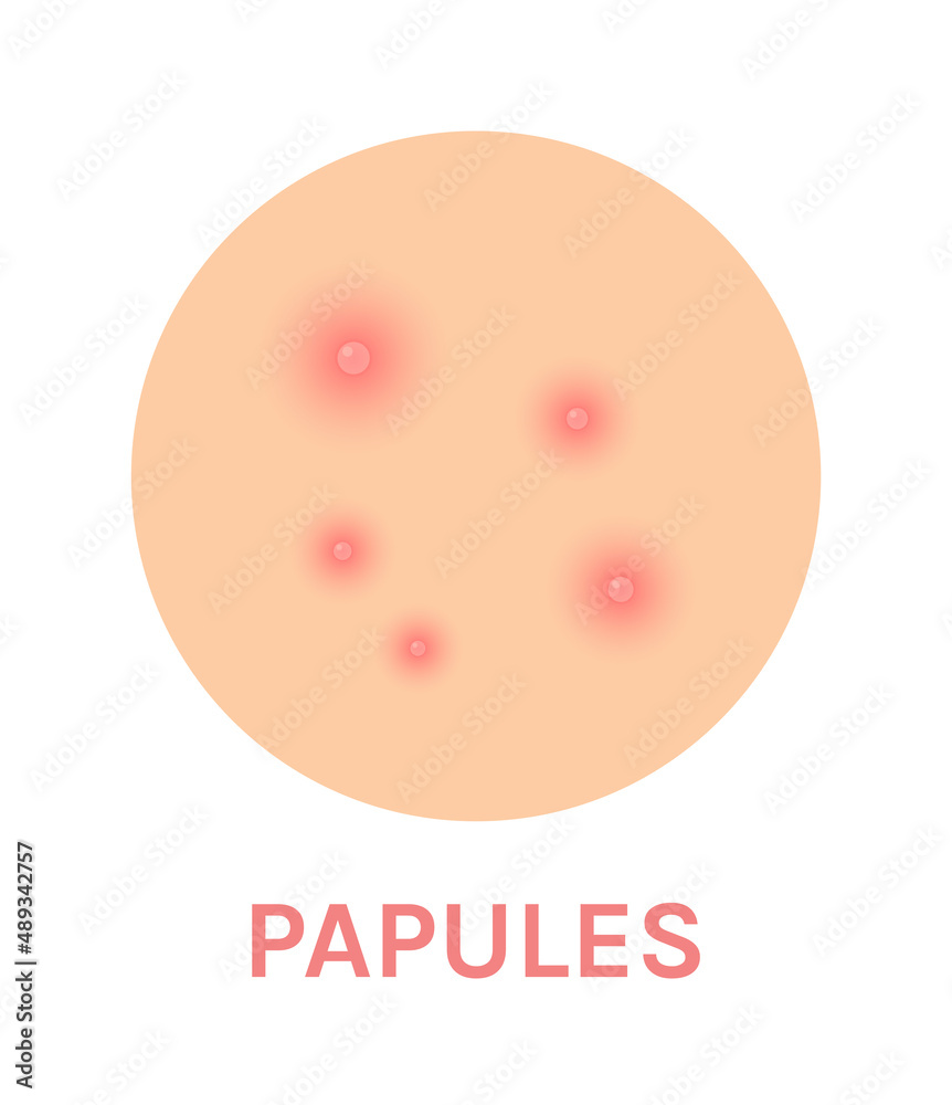 papules skin