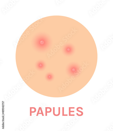 Papules. Acne Icon. Problem Skin. Zoom. Close up of Pimples. Inflammation and Rash. Red Pink Infection. Flat Color Cartoon style. White background. Vector illustration for Beauty and Medical design.
