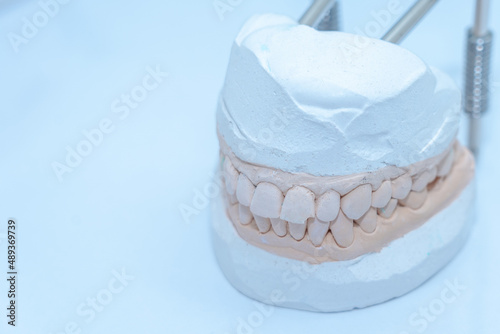 Gypsum jaw model. Dental care