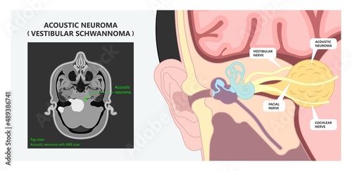 Acoustic neuroma tumor brain nerve inner ear loss cancer test MRI X-RAY  diagnosis meniere's genetic type 2 surgery Noise neuritis head BPPV Benign CT Scan
