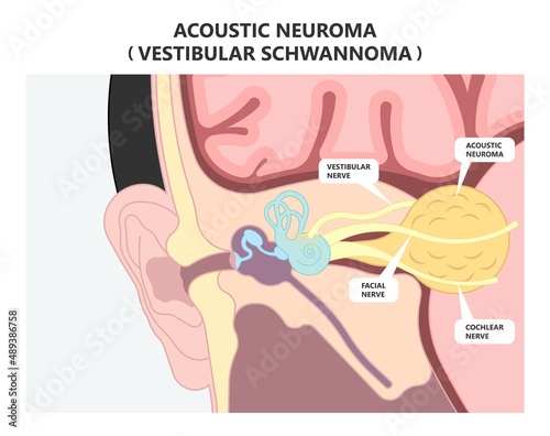 Acoustic neuroma tumor brain nerve inner ear loss cancer test MRI X-RAY  diagnosis meniere's genetic type 2 surgery Noise neuritis head BPPV Benign CT Scan photo